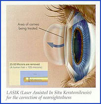 LASIK